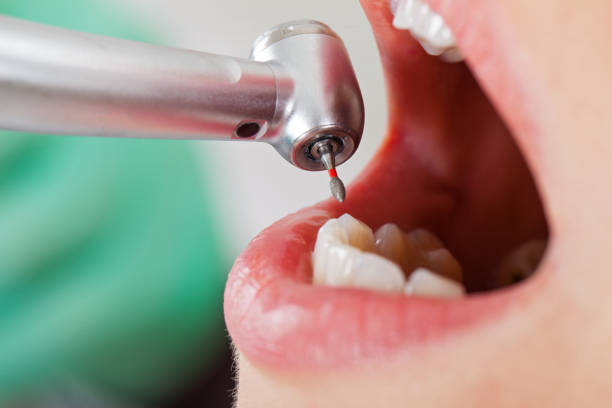 Best Emergency Dental Extractions in Baileys Crossroads, VA